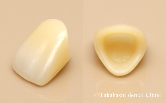 前歯フルジルコニアクラウン
