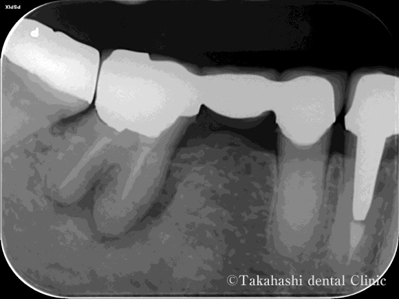 再生治療術前